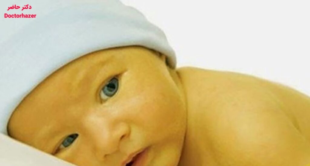 بیلی روبین بالا در نوزادان
