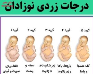 سطح بیلی روبین نوزاد