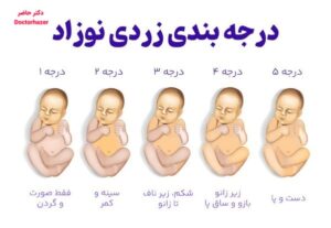 عوارض زردی نوزادان