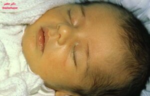 چه دارویی برای زردی نوزاد خوبه؟