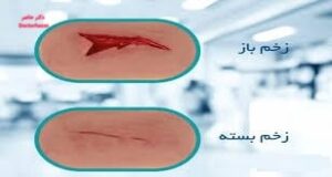 انواع زخم