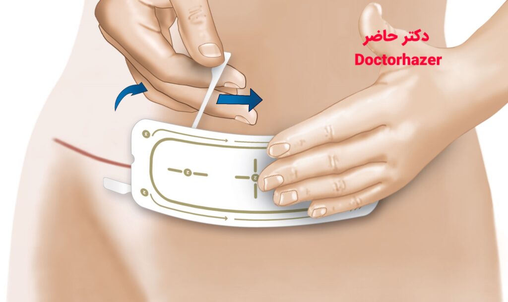 بهداشت زخم جراحی