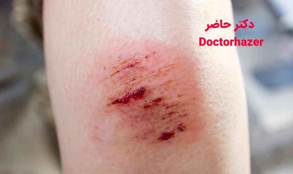 استریل کردن زخم
