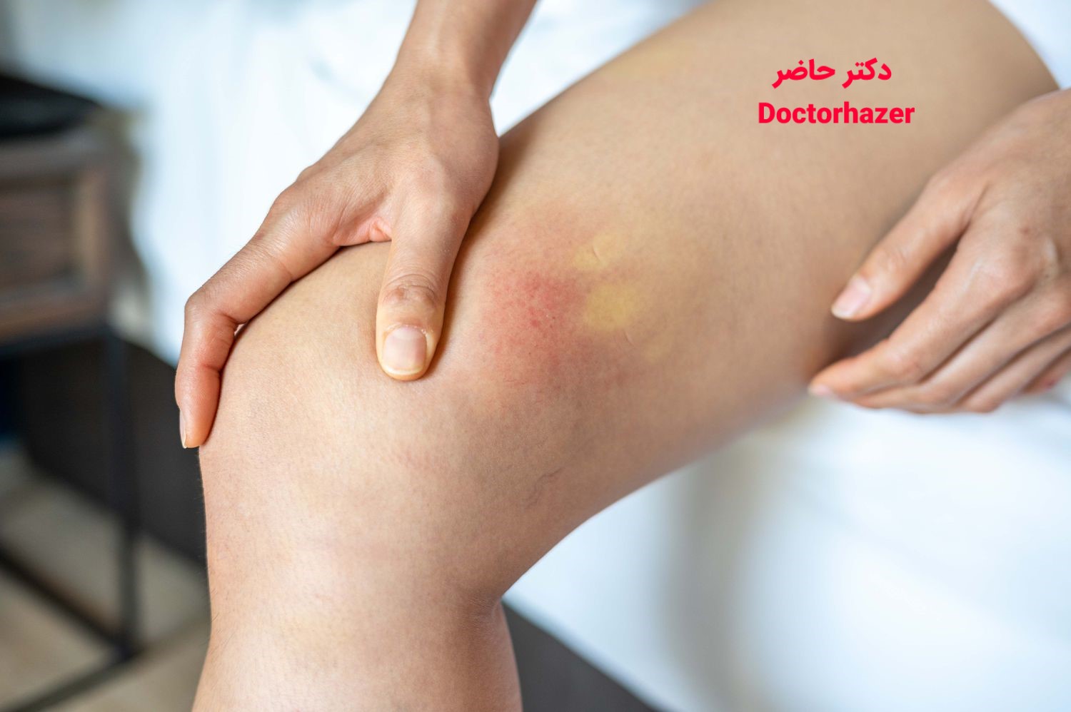 تورم بعد از انفوزیون