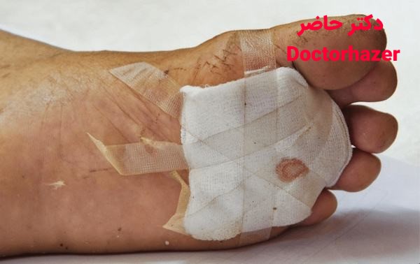 زخم ملتهب