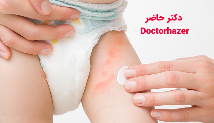 سوختگی ناحیه تناسلی نوزاد