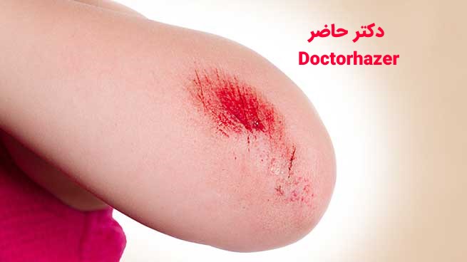 عفونت زخم