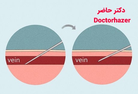 پیشگیری از کبودی