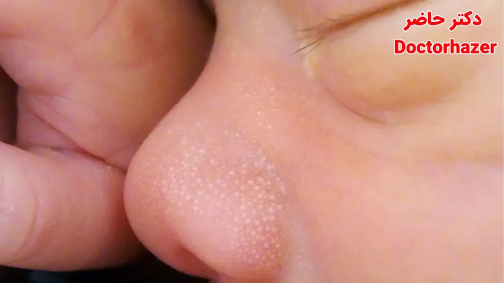 میلیا در نوزادان| جوش های سفید رنگ روی پوست نوزاد چیست