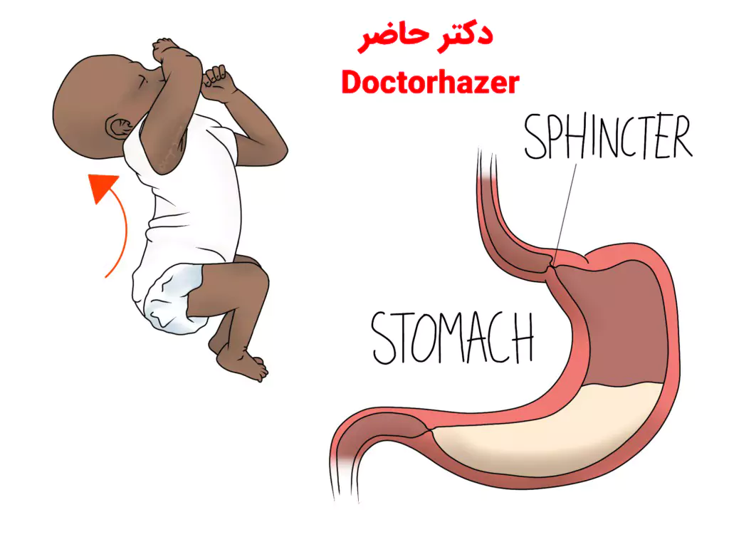 انواع رفلاکس در نوزادان
