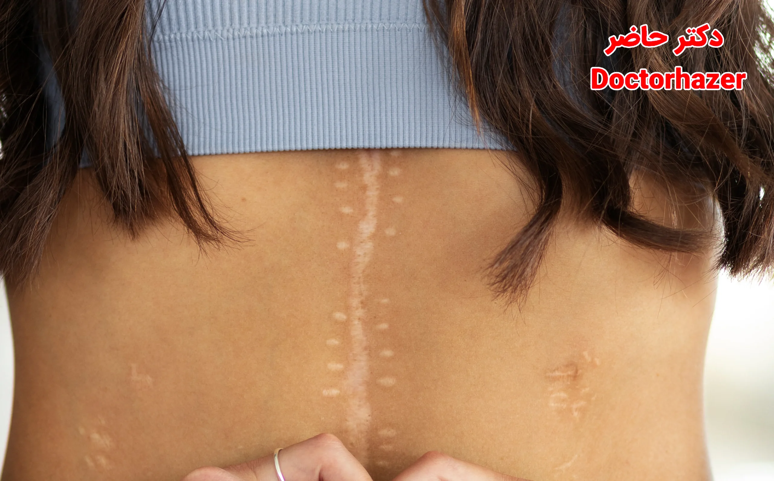 درمان‌های خانگی برای کاهش جای زخم