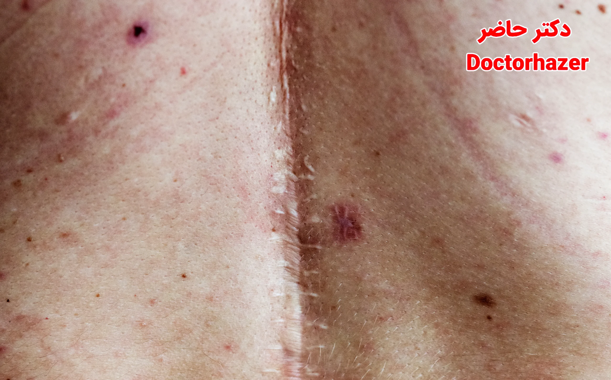 عوامل مؤثر بر ایجاد اسکار و جای زخم