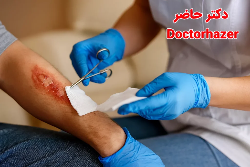 راهنمای کامل درمان سوختگی در منزل| روش های ایمن و موثر