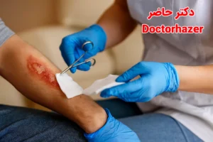 راهنمای کامل درمان سوختگی در منزل| روش های ایمن و موثر