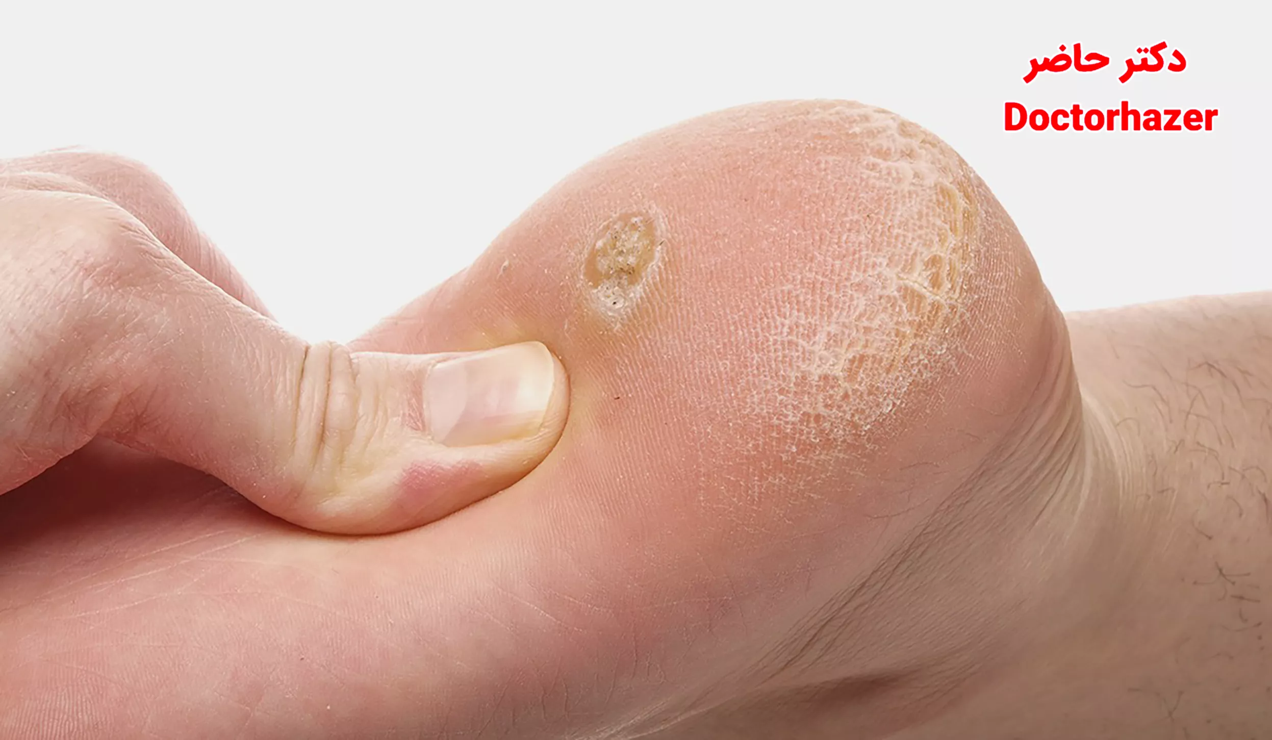 چه زمانی نیاز به مراجعه به متخصص درمان میخچه دارید؟