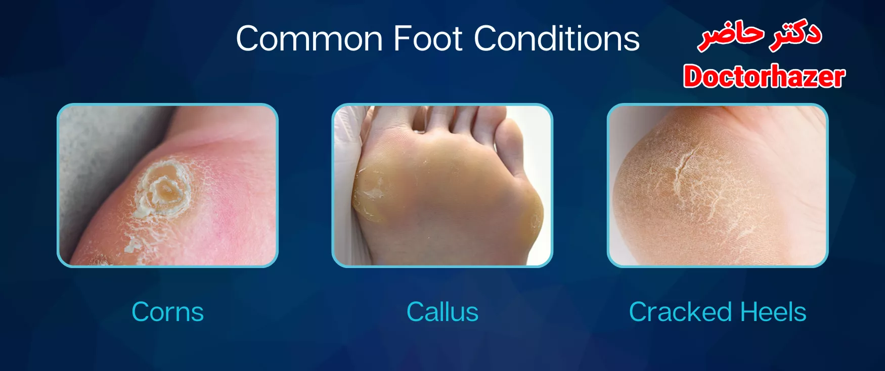 درمان‌های طبیعی و گیاهی موثر برای میخچه