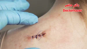 راهنمای ایمن کشیدن بخیه در منزل| زمان، روش و احتیاط ها