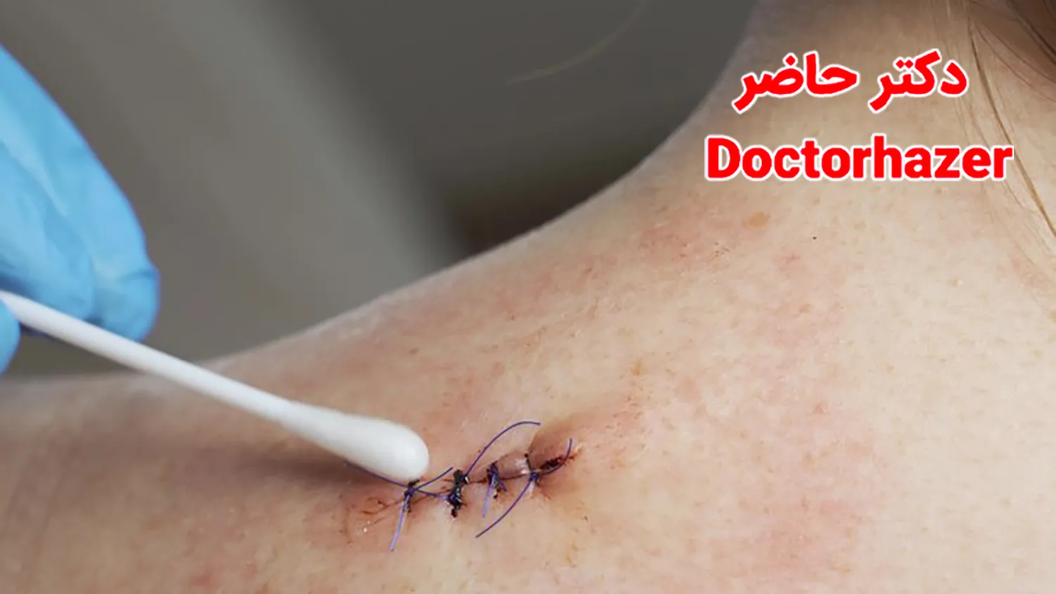 چه زمانی می‌توان بخیه را در منزل کشید؟