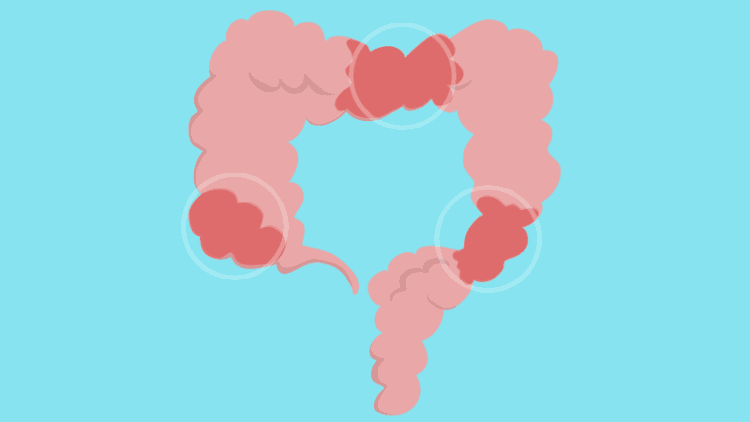 درمان سندرم روده تحریک پذیر | راهنمای کامل علائم، رژیم غذایی و روش های درمانی