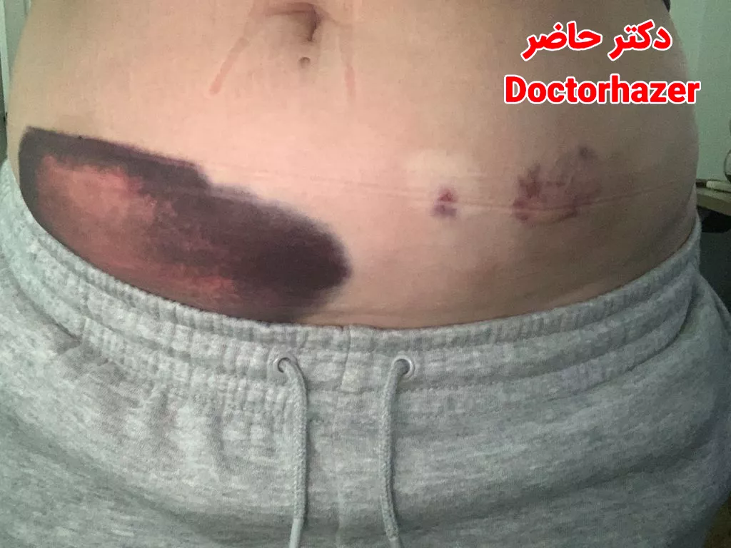 درمان طبیعی کبودی پس از تزریق انوکساپارین