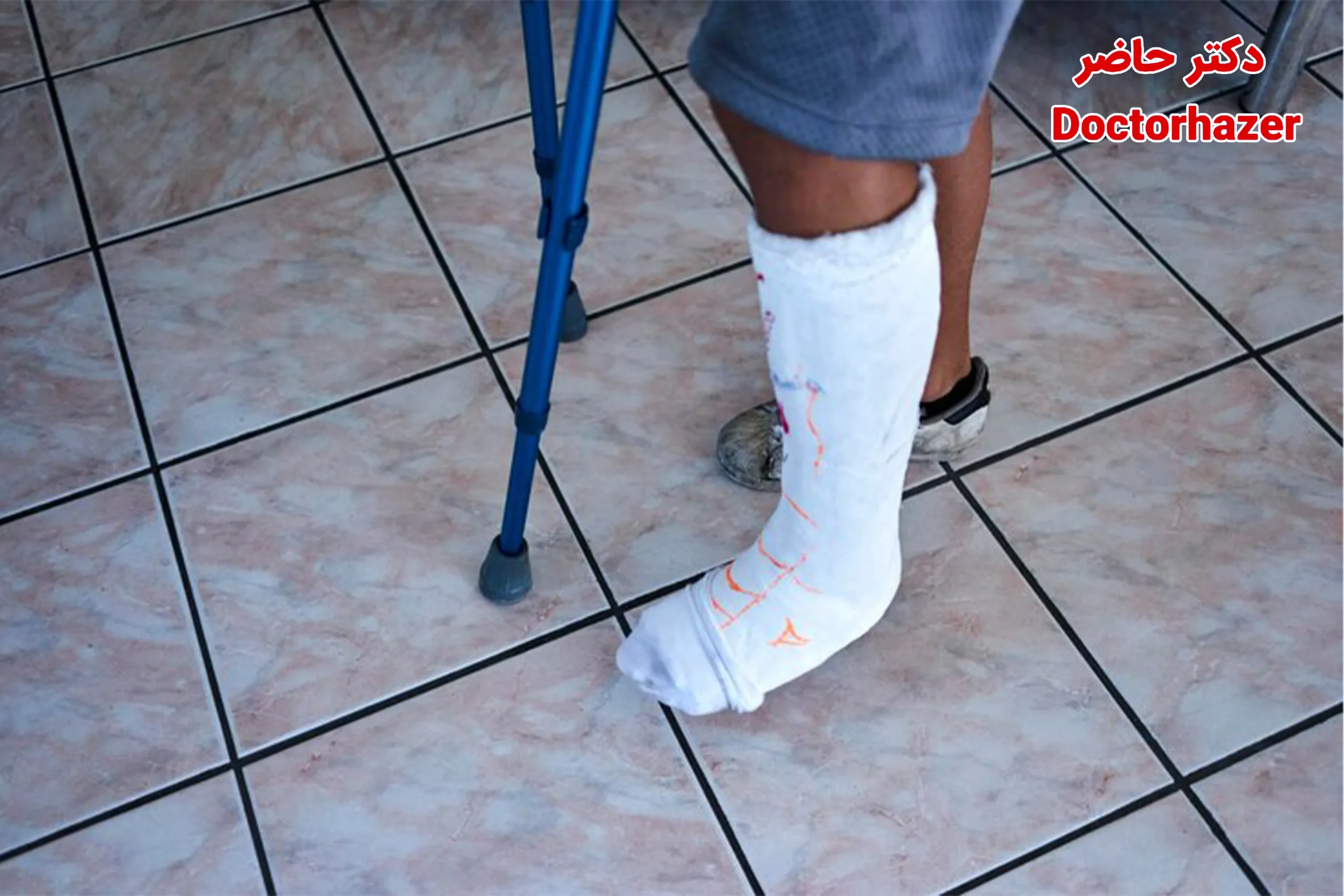 مراحل ایمن باز کردن گچ پا قدم به قدم