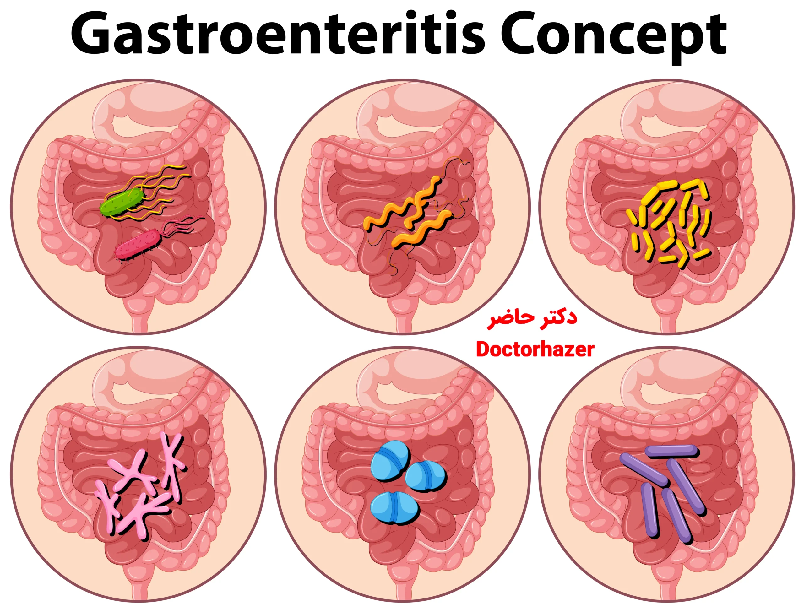 علت ایجاد سندرم روده تحریکپذیر (IBS) و علائم آن