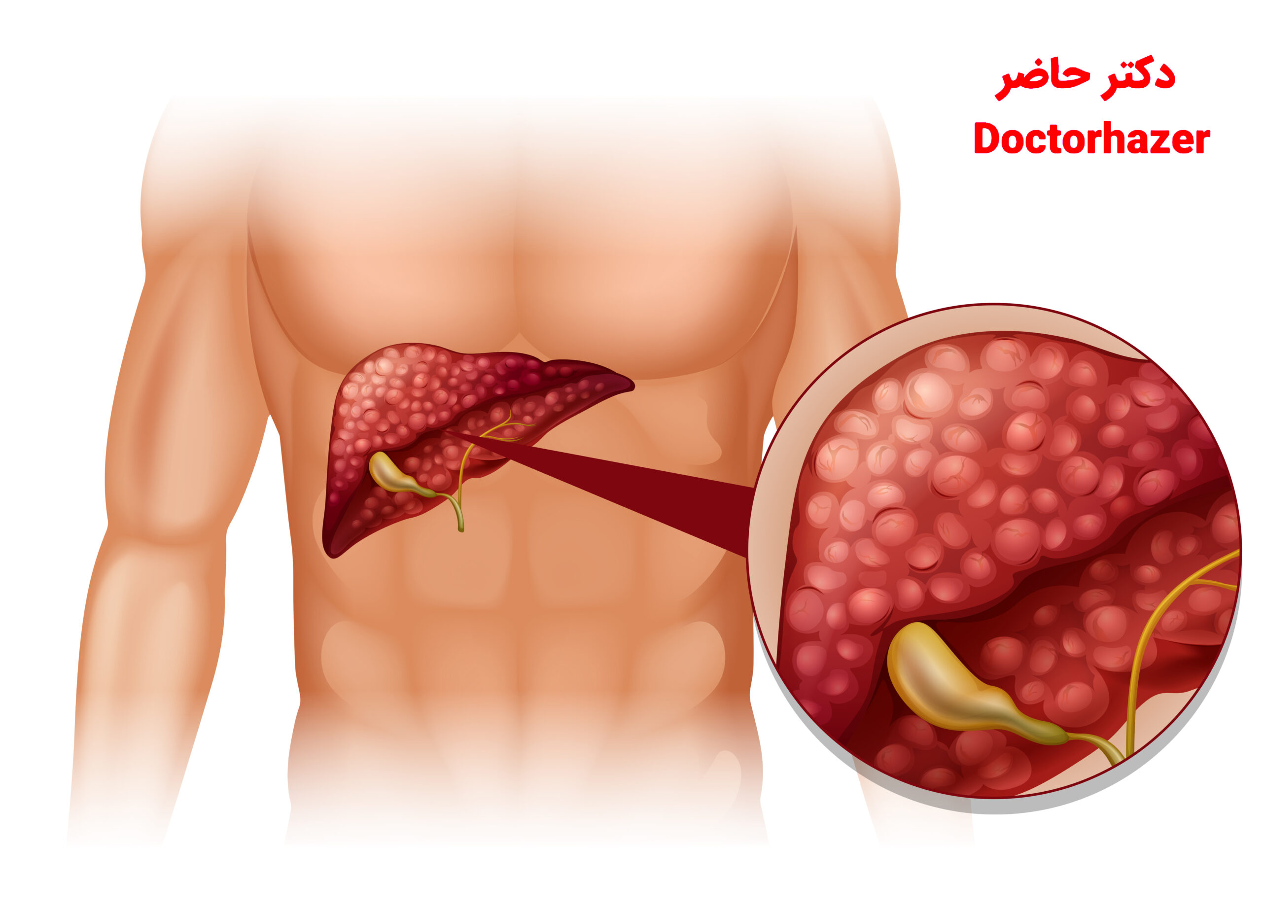 مدیریت کبد چرب