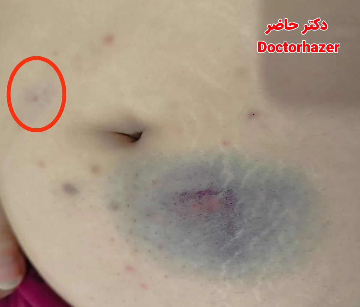 روش‌های پیشگیری از کبودی قبل از تزریق