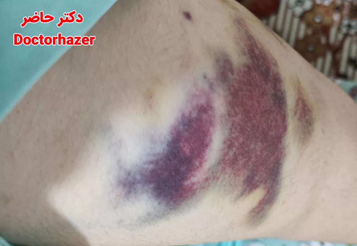 چرا پس از تزریق انوکساپارین کبودی ایجاد می‌شود؟