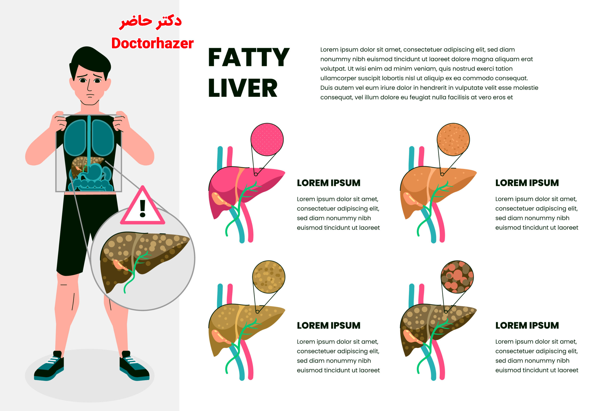 علتهای اصلی ایجاد کبد چرب چیست؟