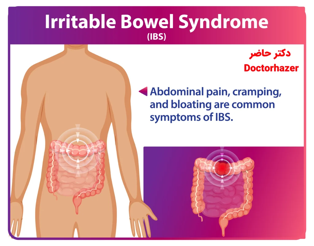 درمان سندرم روده تحریک پذیر