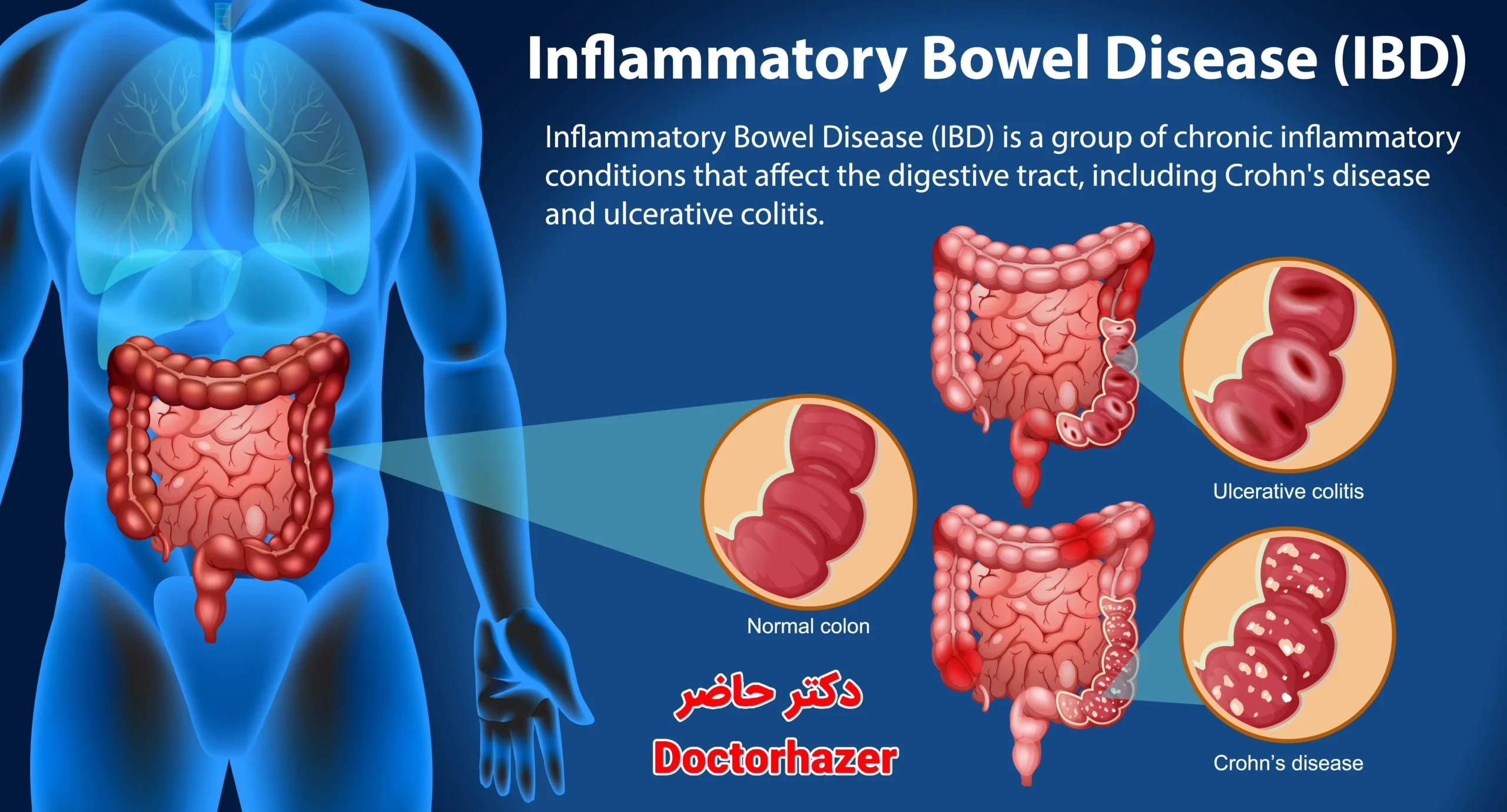 سوالات متداول در مورد سندرم روده تحریک پذیر