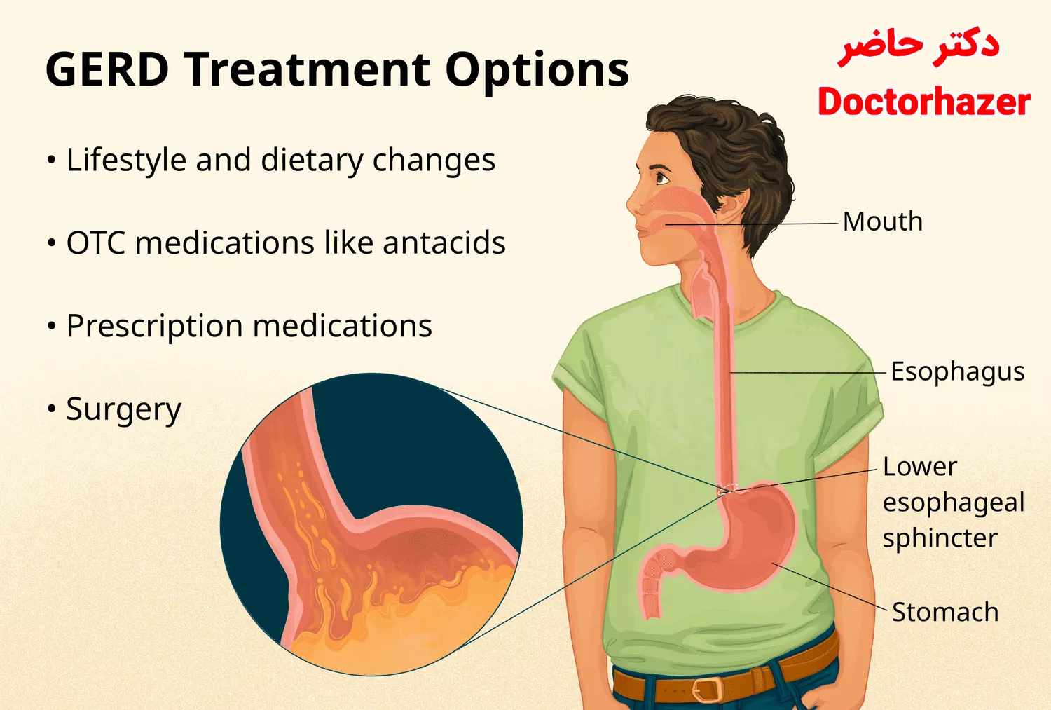 بهترین روش‌های درمان خانگی رفلاکس معده
