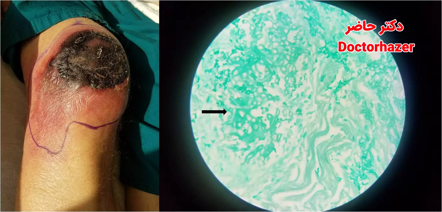 تشخیص افتراقی با عفونت باکتریایی