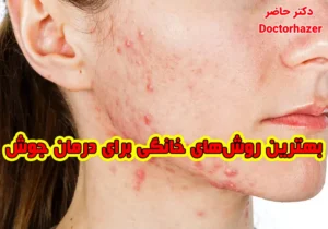 بهترین روشهای خانگی برای درمان جوش صورت