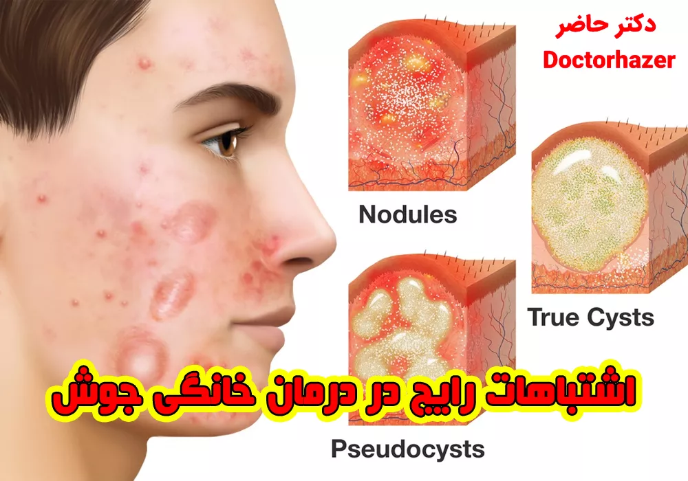 چرا جوش‌های صورت ایجاد می‌شوند؟